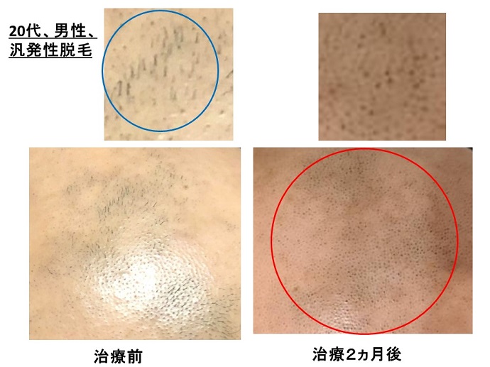 円形脱毛症　病院